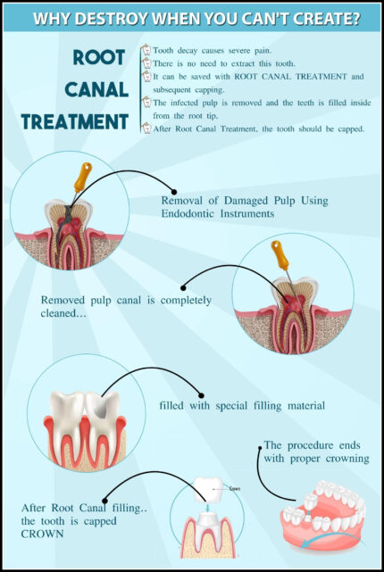 Root Canal Treatment Poster